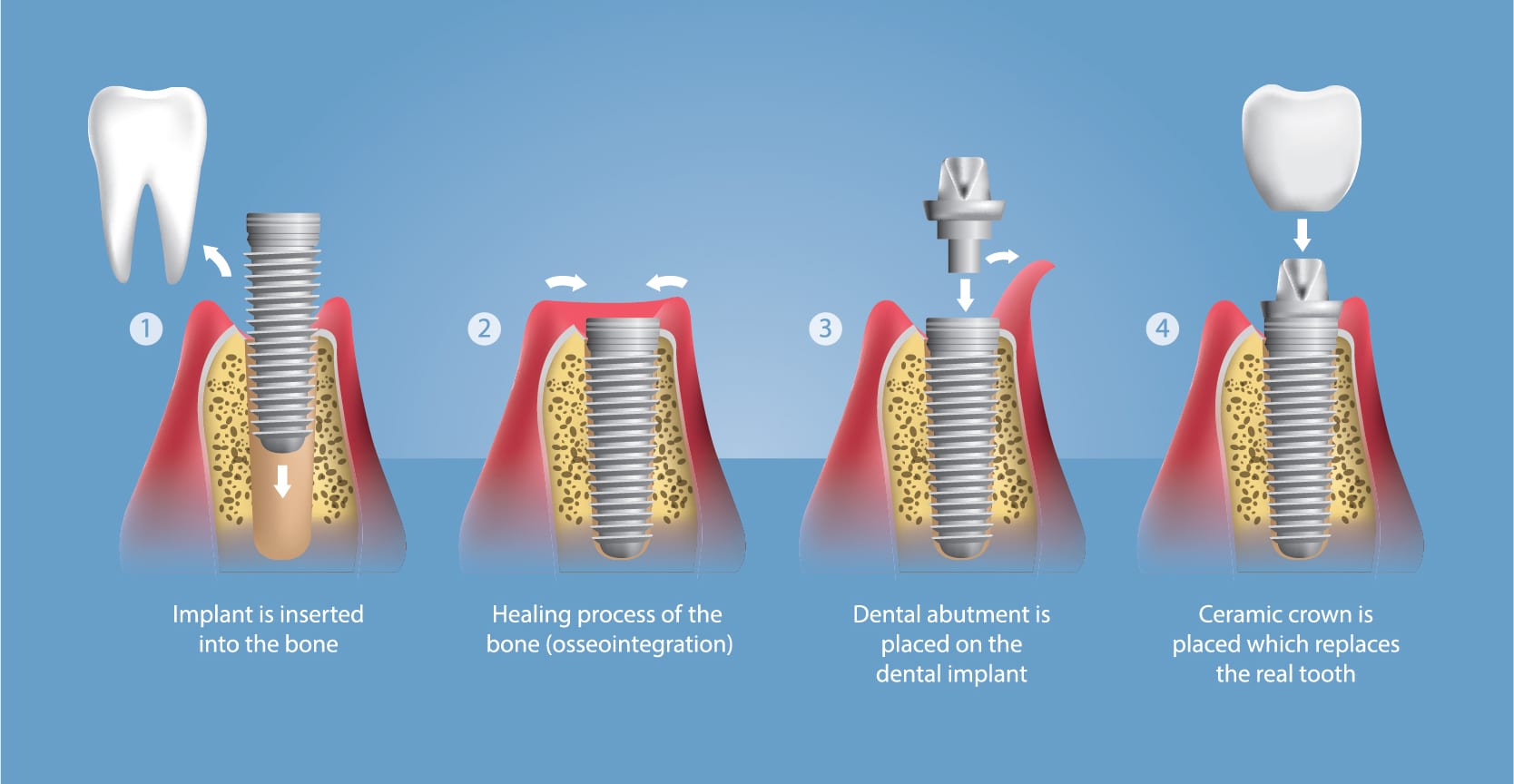 Dental Implants in Searcy AR